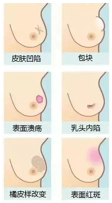 “乳腺癌征象图”，乳腺自查方法女性一定要知道！